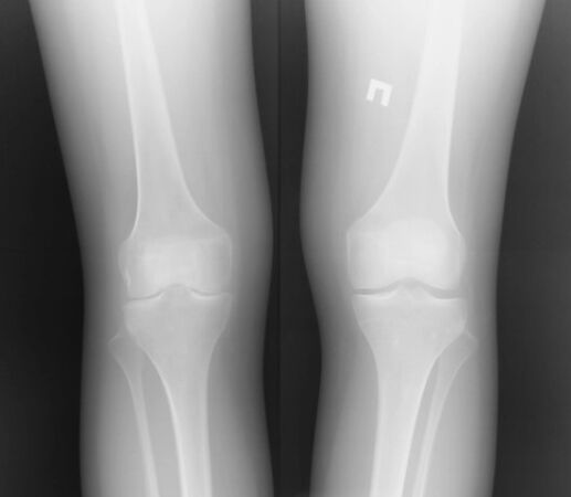 Põlveliigese radiograafia