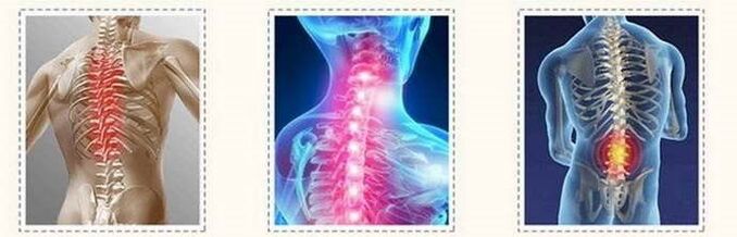 osteokondroos lülisamba kahjustused